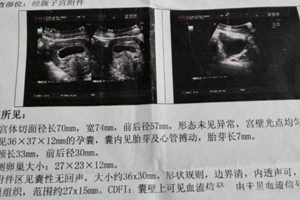郑州做供卵,45岁多囊卵巢综合征，在深圳北大医院做试管成功率是多少？_做试